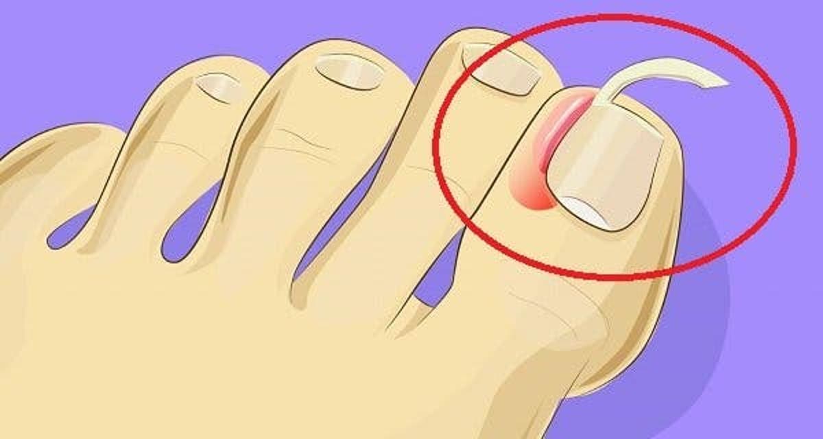 Ongle incarné au pied que faire pour le soigner ? CetViral — free download